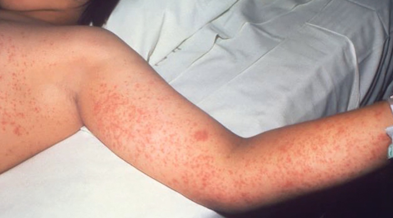 cases measles canada: disinformation worries new